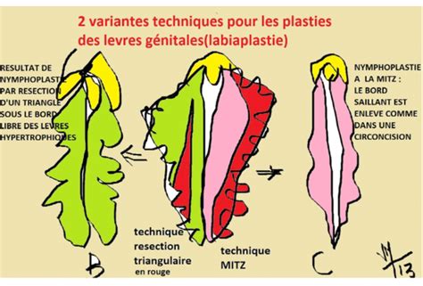 grosse levre|Hypertrophie des lèvres vaginales : Nymphoplastie médicale ou。